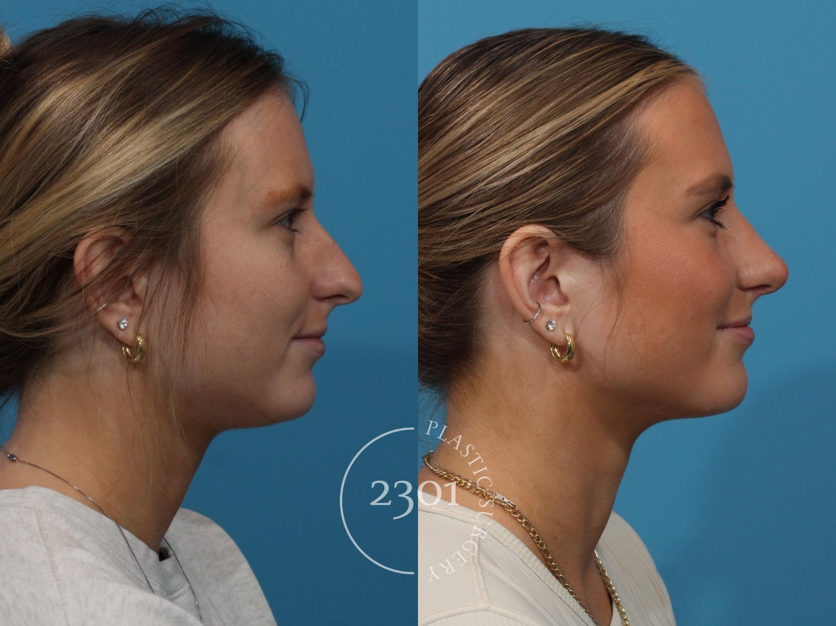 Before & After Rhinoplasty Case 865 Right Side View in Fort Worth, Plano, & Frisco, Texas