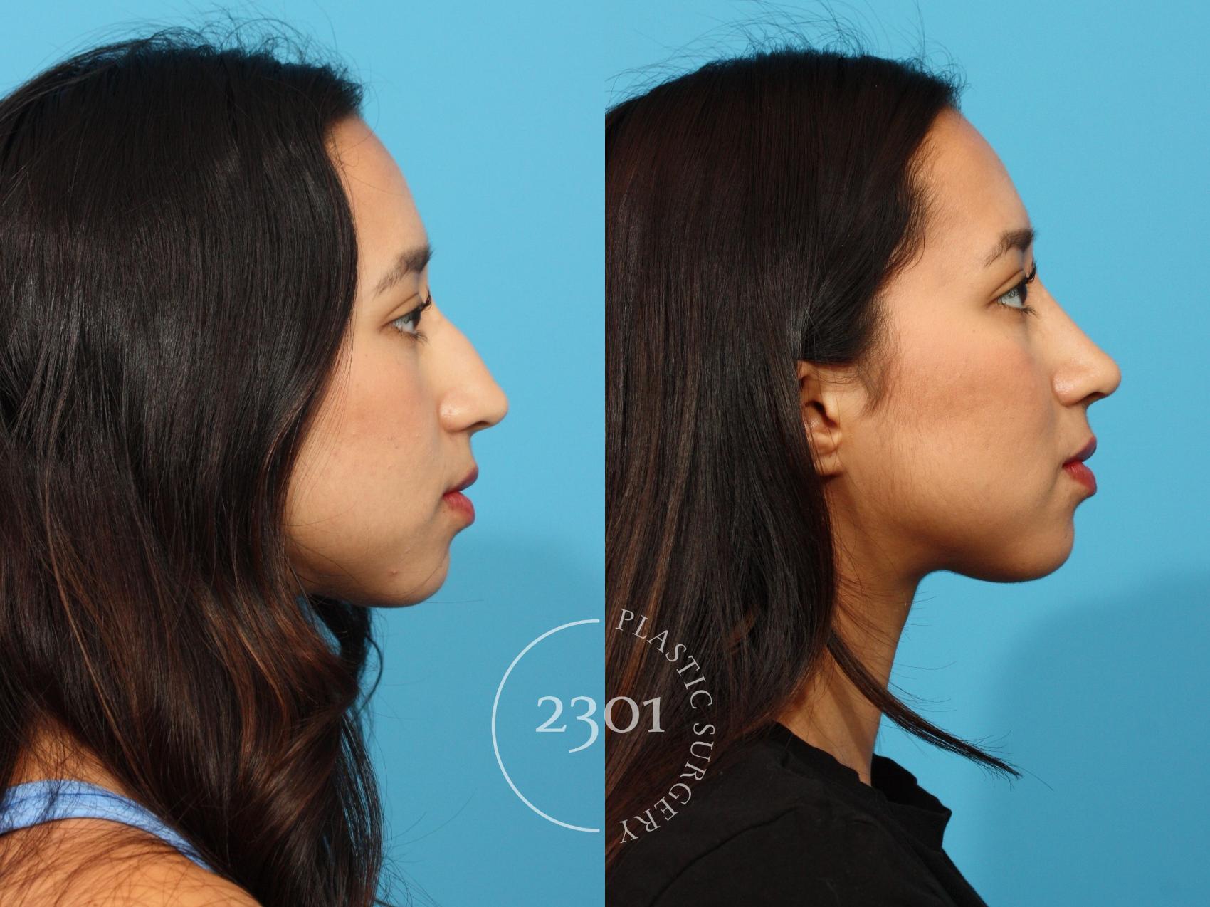 Before & After Rhinoplasty Case 871 Right Side View in Fort Worth, Plano, & Frisco, Texas
