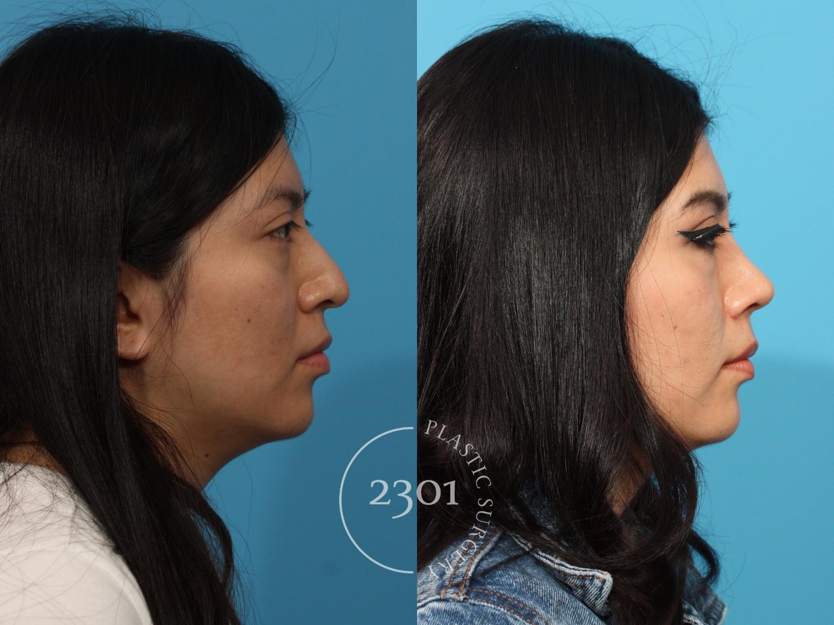 Before & After Rhinoplasty Case 872 Right Side View in Fort Worth, Plano, & Frisco, Texas