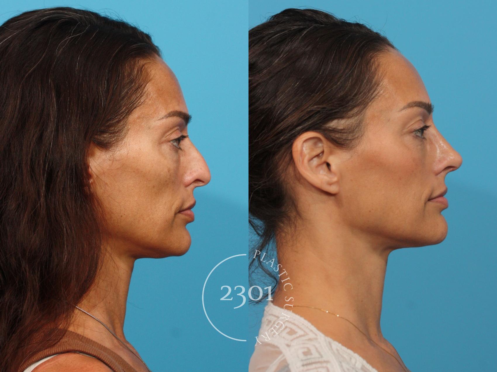 Before & After Rhinoplasty Case 888 Right Side View in Fort Worth, Plano, & Frisco, Texas