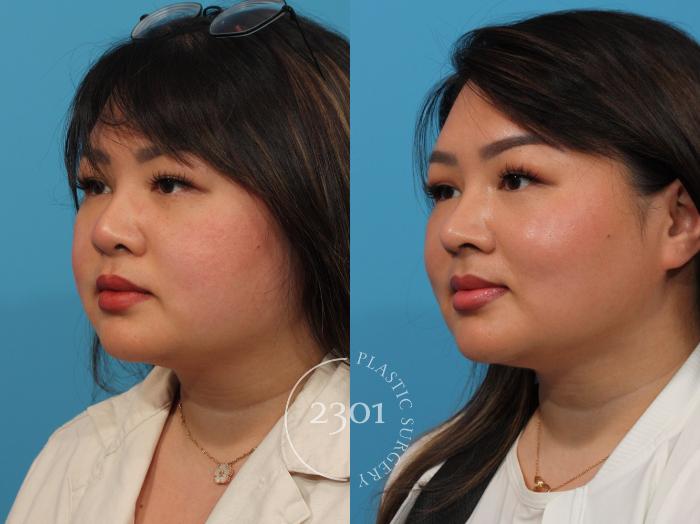Before & After Neck Liposuction Case 892 Left Oblique View in Fort Worth, Plano, & Frisco, Texas