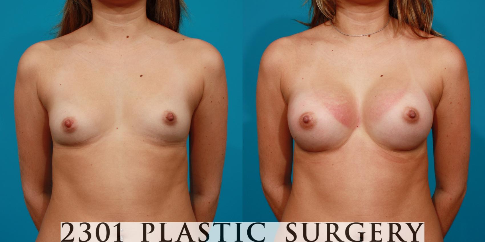 Before & After Saline Implants Case 87 View #1 View in Fort Worth, Plano, & Frisco, Texas