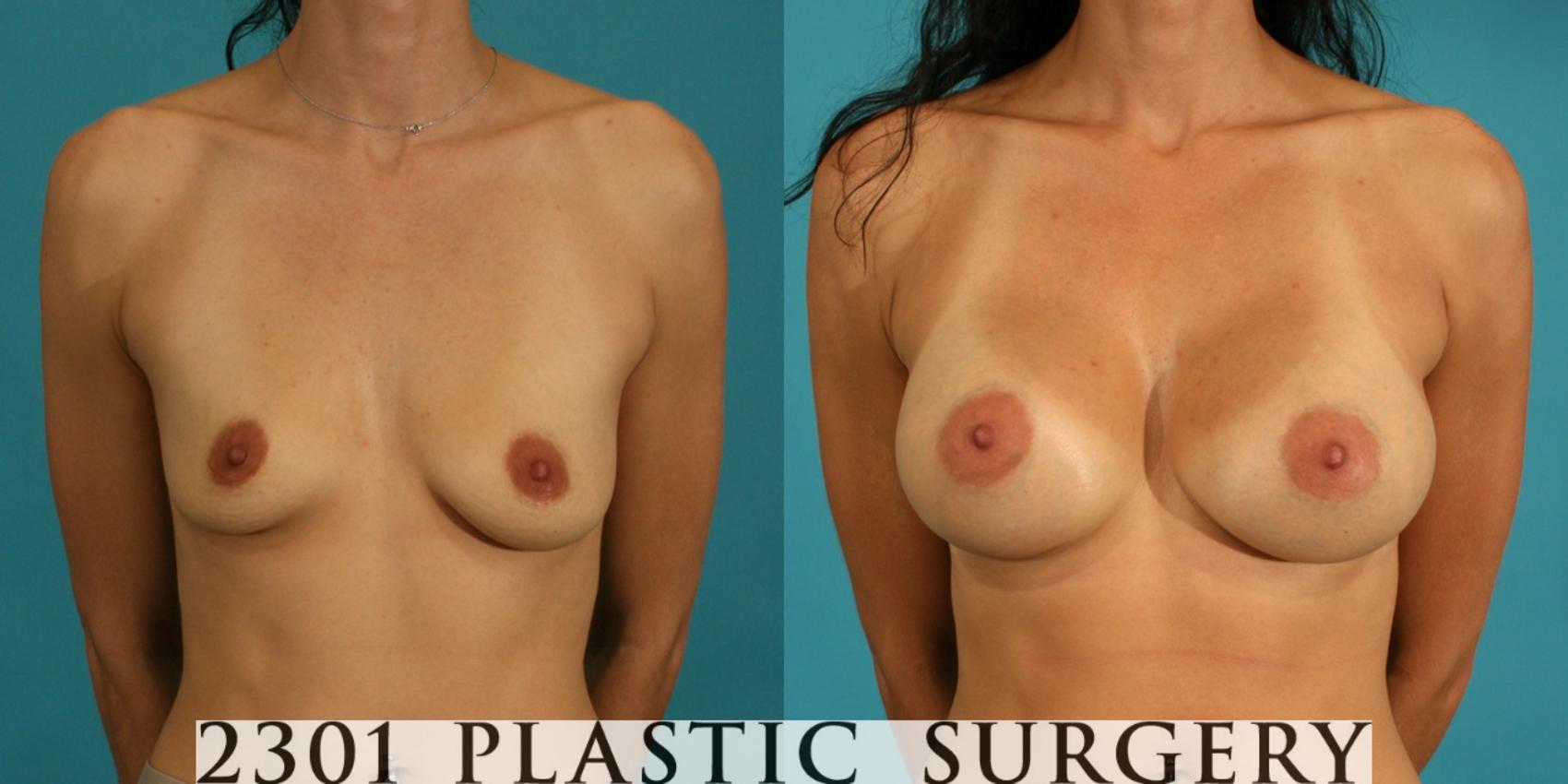 Before & After Silicone Implants Case 9 View #1 View in Fort Worth, Plano, & Frisco, Texas