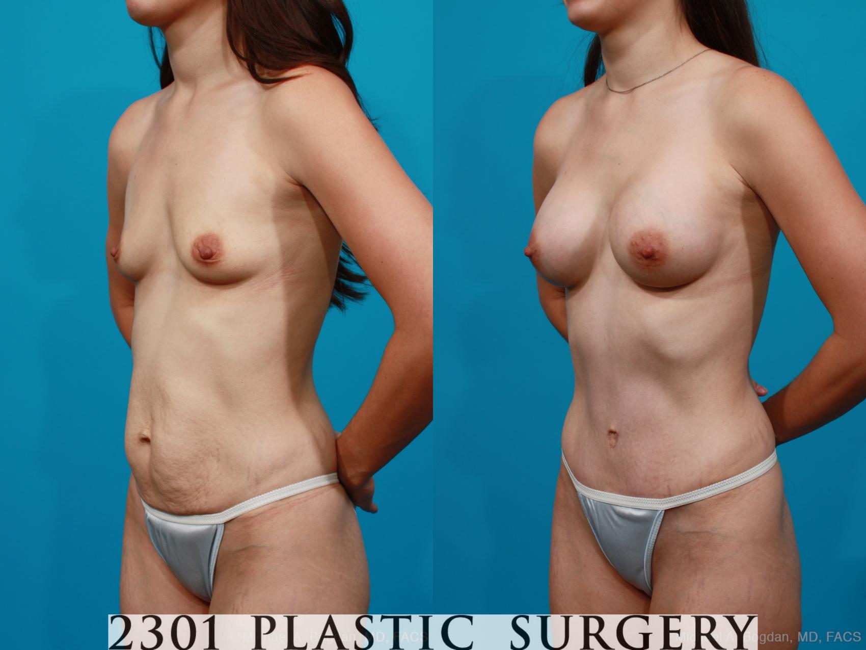 Before & After Tummy Tuck Case 175 View #3 View in Fort Worth, Plano, & Frisco, Texas