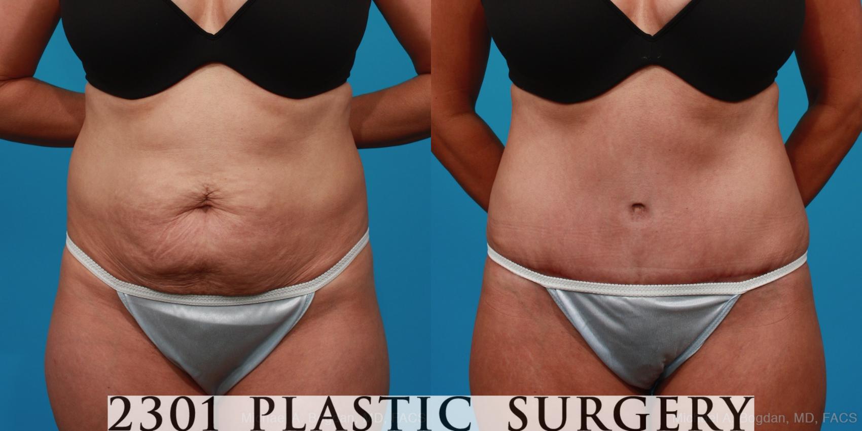 Before & After Tummy Tuck Case 294 View #1 View in Fort Worth, Plano, & Frisco, Texas