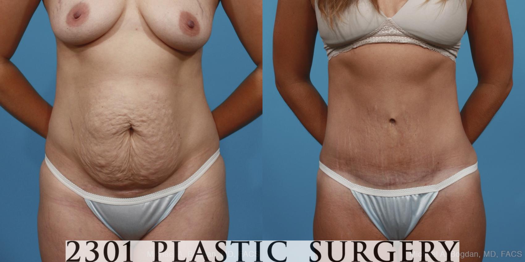 Before & After Tummy Tuck Case 370 View #1 View in Fort Worth, Plano, & Frisco, Texas