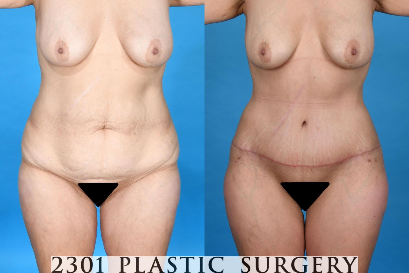 Before & After Tummy Tuck Case 740 Front View in Fort Worth, Plano, & Frisco, Texas