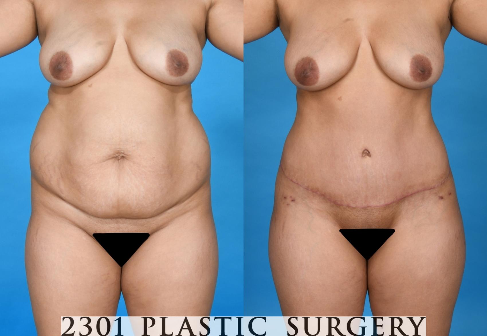 Before & After Tummy Tuck Case 741 Front View in Fort Worth, Plano, & Frisco, Texas