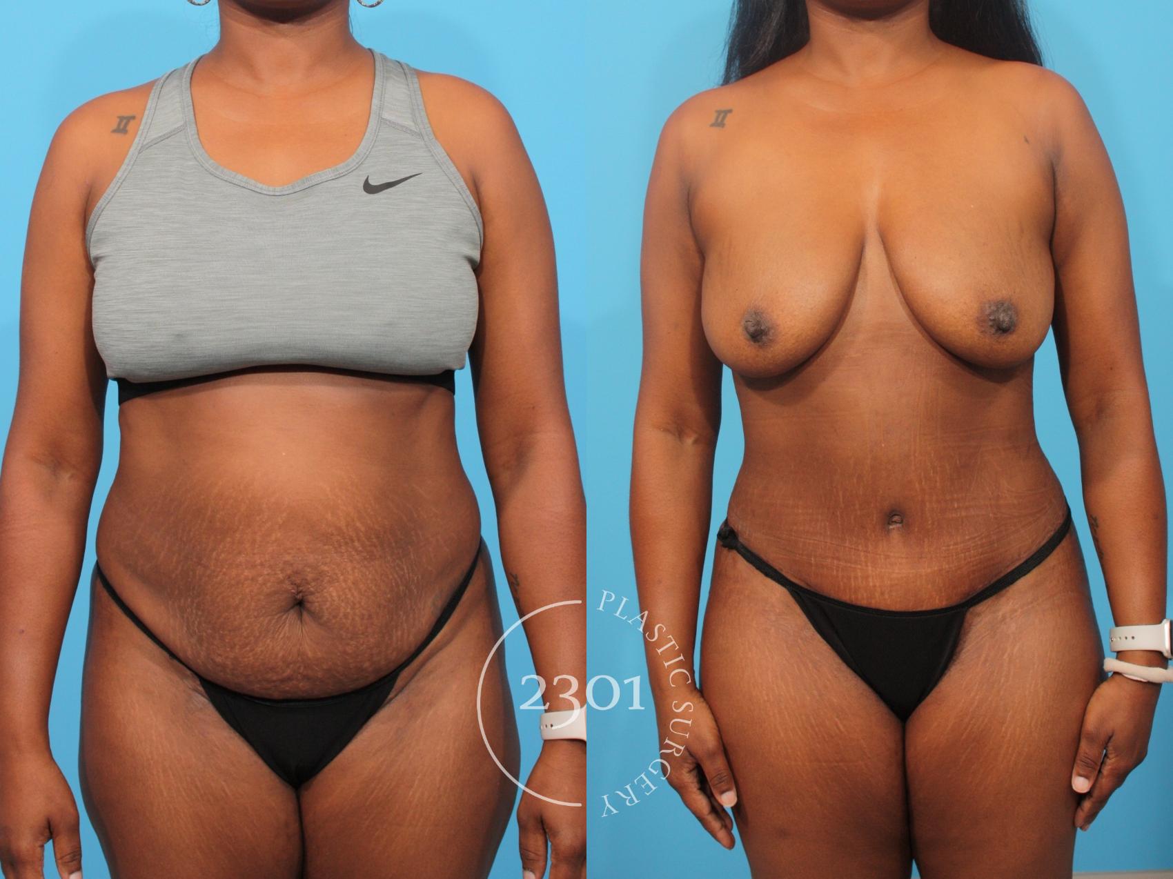 Before & After Tummy Tuck Case 849 Front View in Fort Worth, Plano, & Frisco, Texas