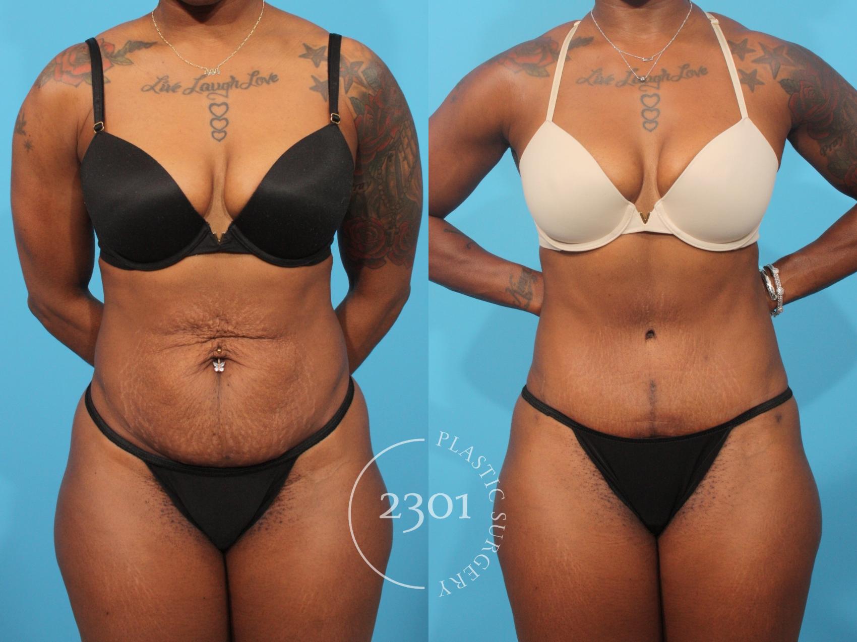 Before & After Tummy Tuck Case 868 Front View in Fort Worth, Plano, & Frisco, Texas