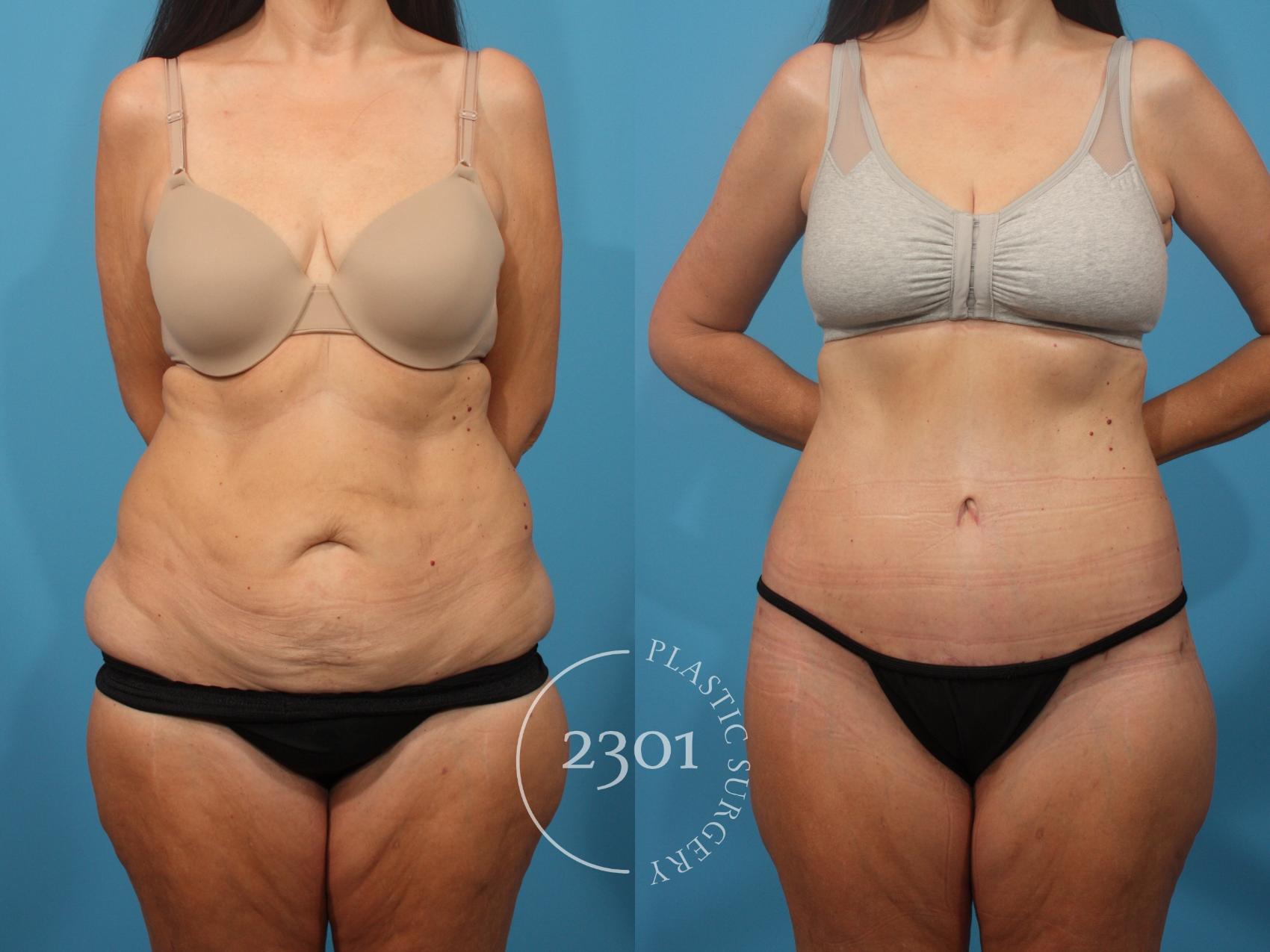 Before & After Tummy Tuck Case 875 Front View in Fort Worth, Plano, & Frisco, Texas