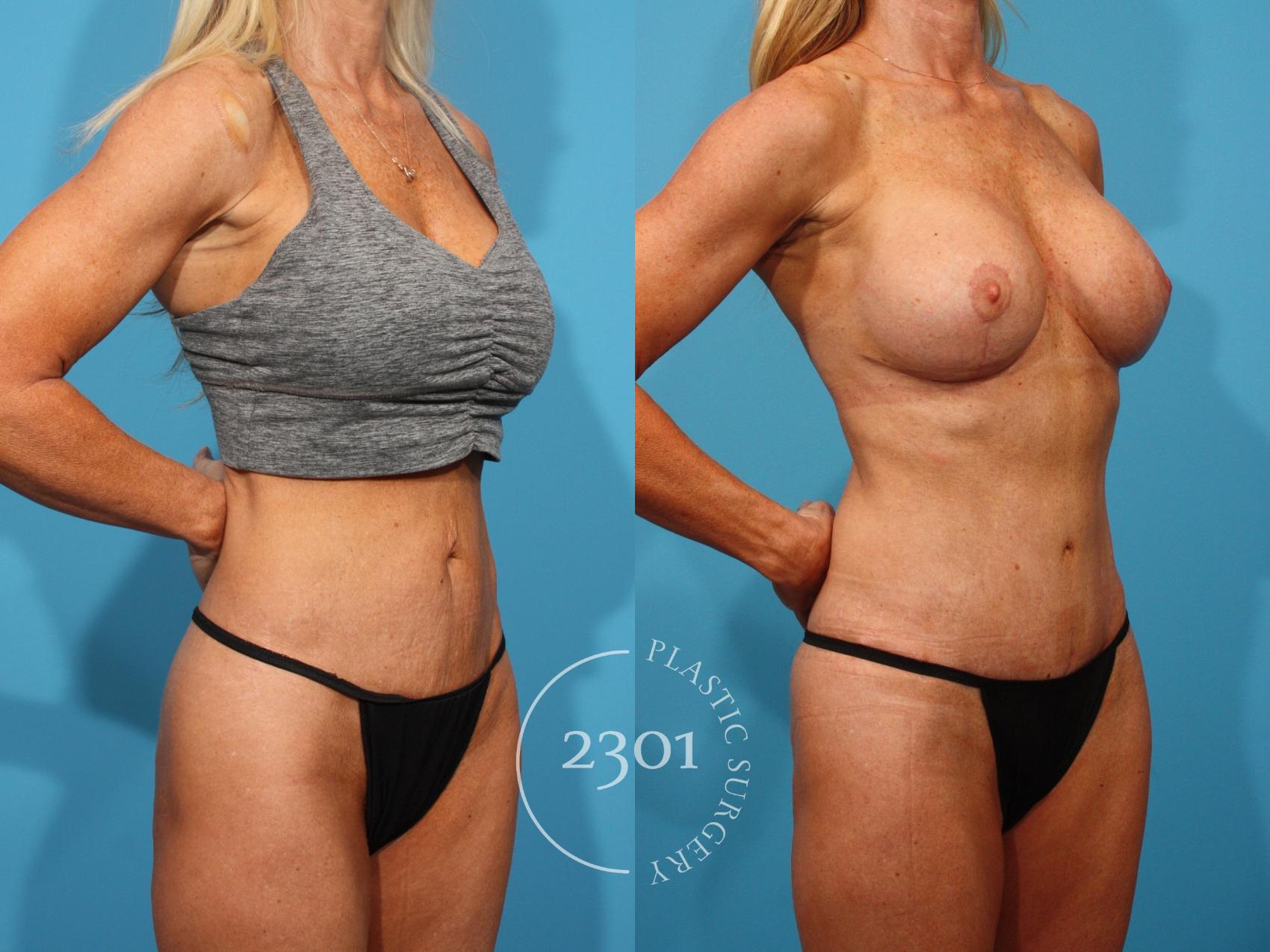 Before & After Mommy Makeover Case 891 Right Oblique View in Fort Worth, Plano, & Frisco, Texas