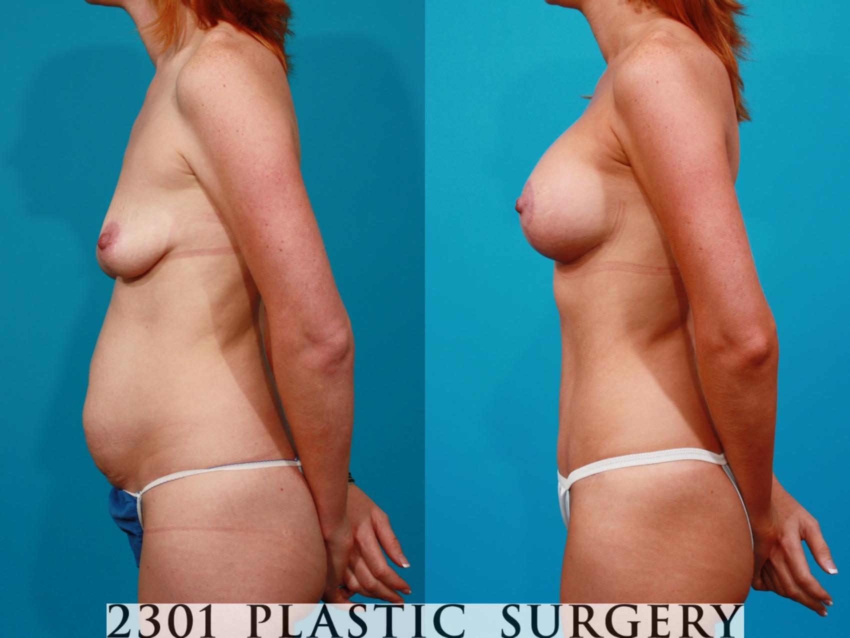 Before & After Tummy Tuck Case 96 View #2 View in Fort Worth, Plano, & Frisco, Texas
