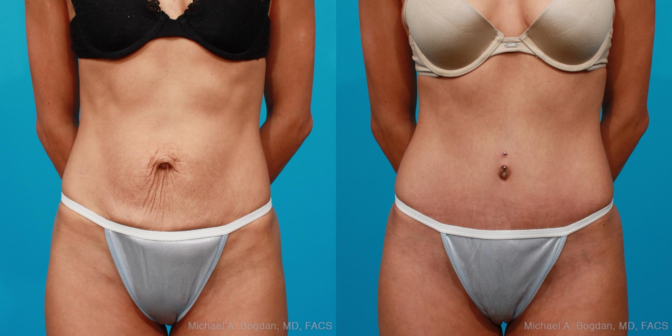 Before & After Tummy Tuck Case 134 View #4 View in Fort Worth & Frisco, Texas