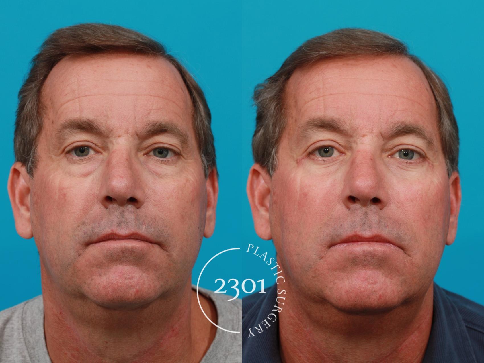 Before & After Male Eyelid Surgery Case 119 View #1 View in Fort Worth, Plano, & Frisco, Texas