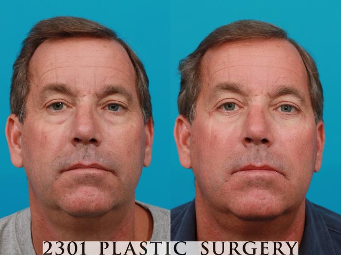 Before & After Male Eyelid Surgery Case 119 View #1 View in Fort Worth & Frisco, Texas
