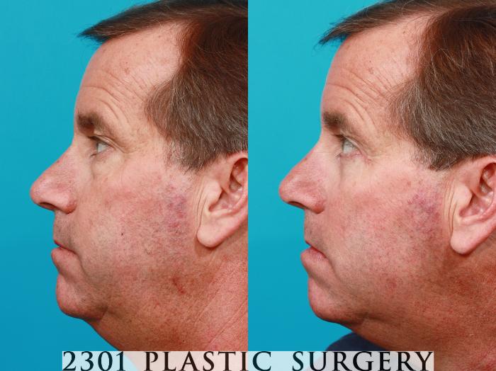 Before & After Blepharoplasty Case 119 View #2 View in Fort Worth, Plano, & Frisco, Texas