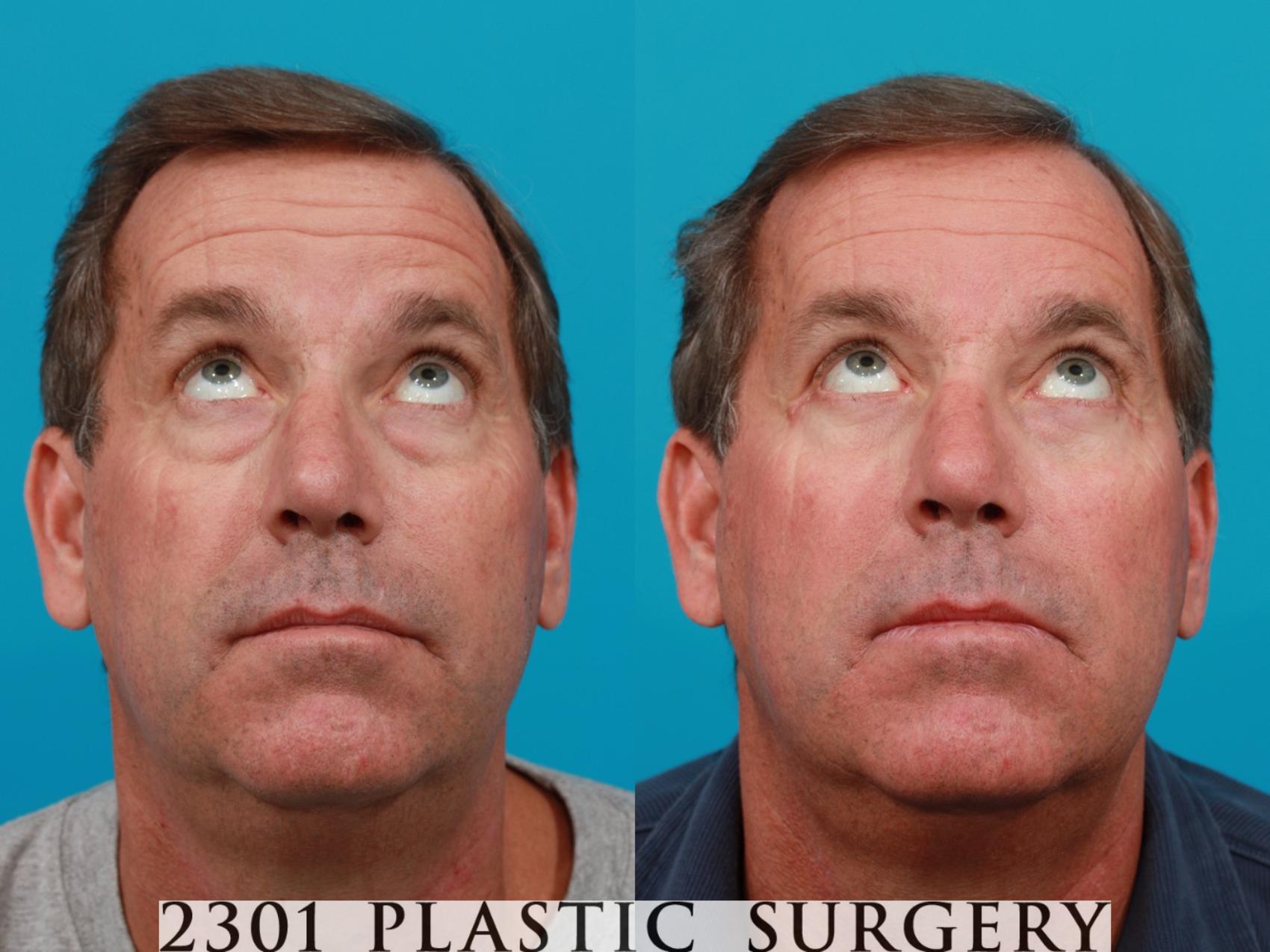 Before & After Blepharoplasty Case 119 View #3 View in Fort Worth & Frisco, Texas