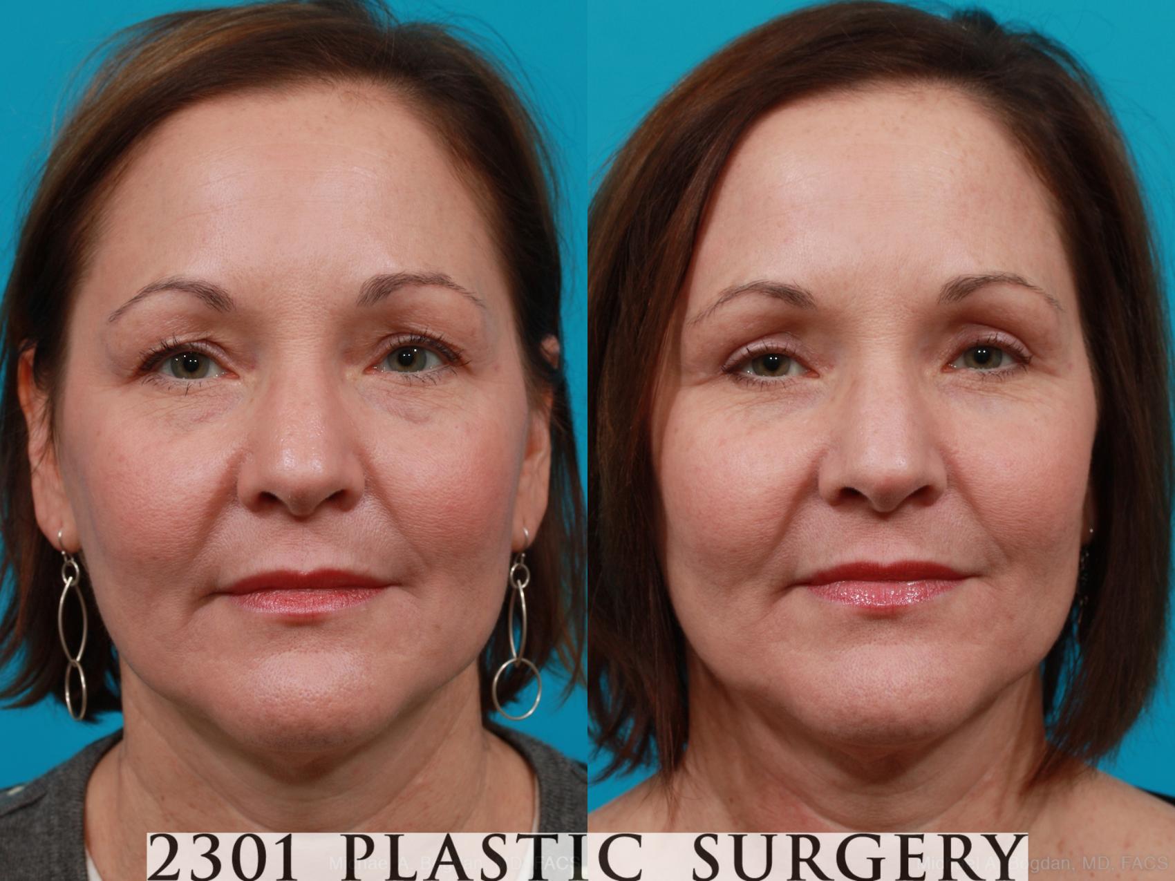 Before & After Blepharoplasty Case 168 View #1 View in Fort Worth, Plano, & Frisco, Texas