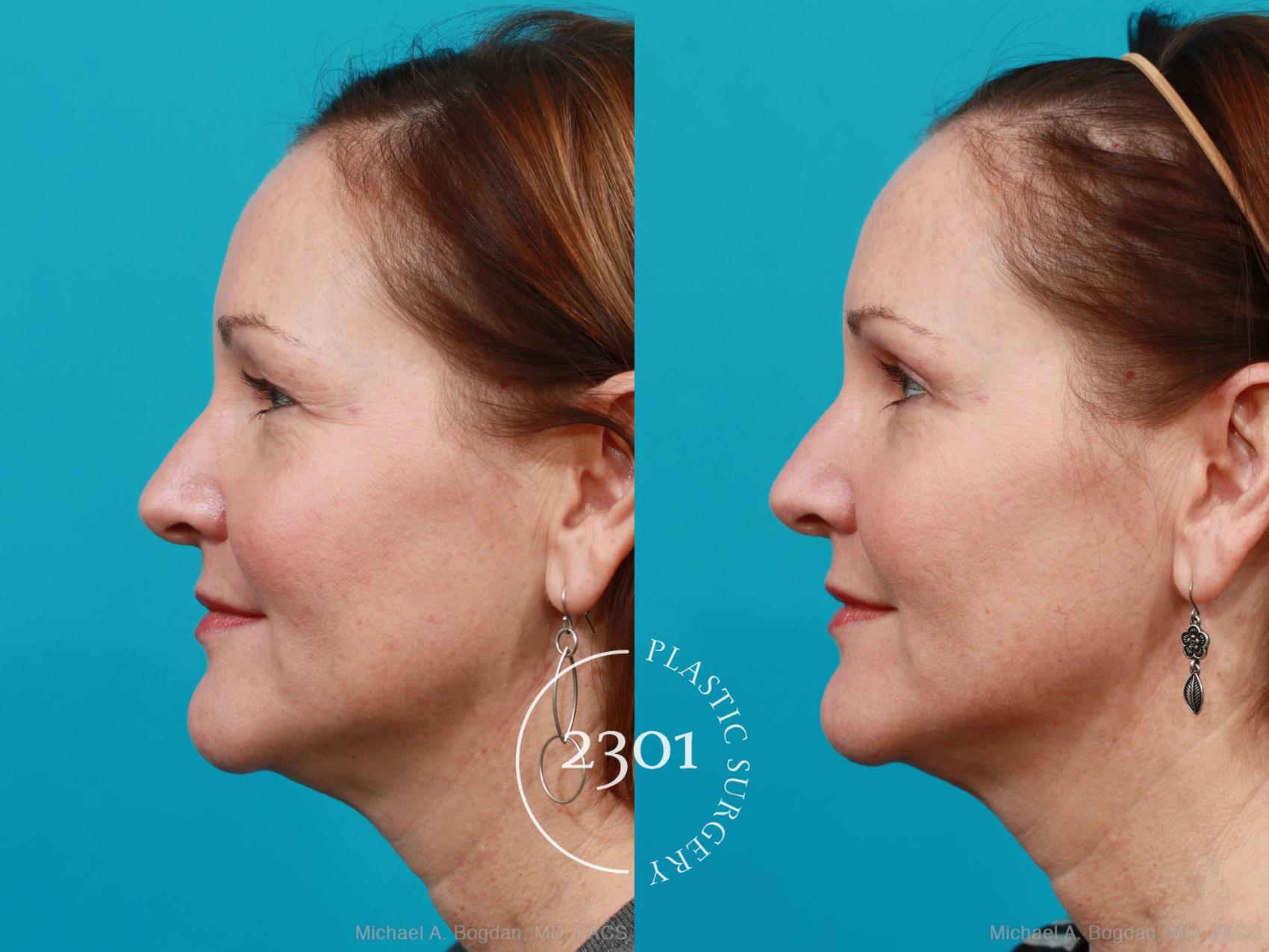 Before & After Eyelid Surgery (Upper) Case 168 View #2 View in Fort Worth, Plano, & Frisco, Texas