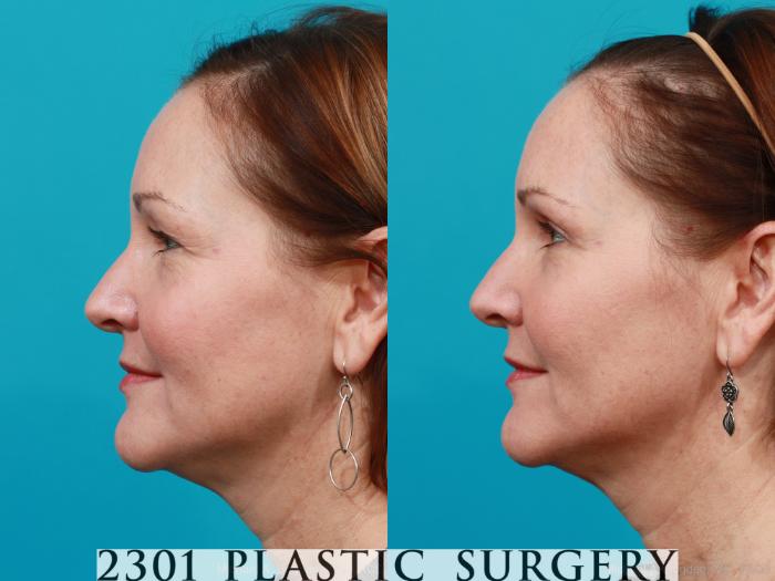 Before & After Blepharoplasty Case 168 View #2 View in Fort Worth, Plano, & Frisco, Texas