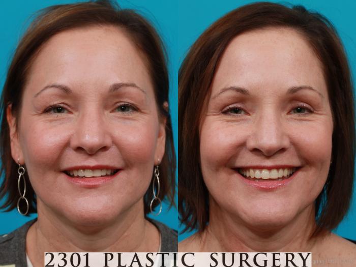 Before & After Eyelid Surgery (Upper) Case 168 View #3 View in Fort Worth, Plano, & Frisco, Texas