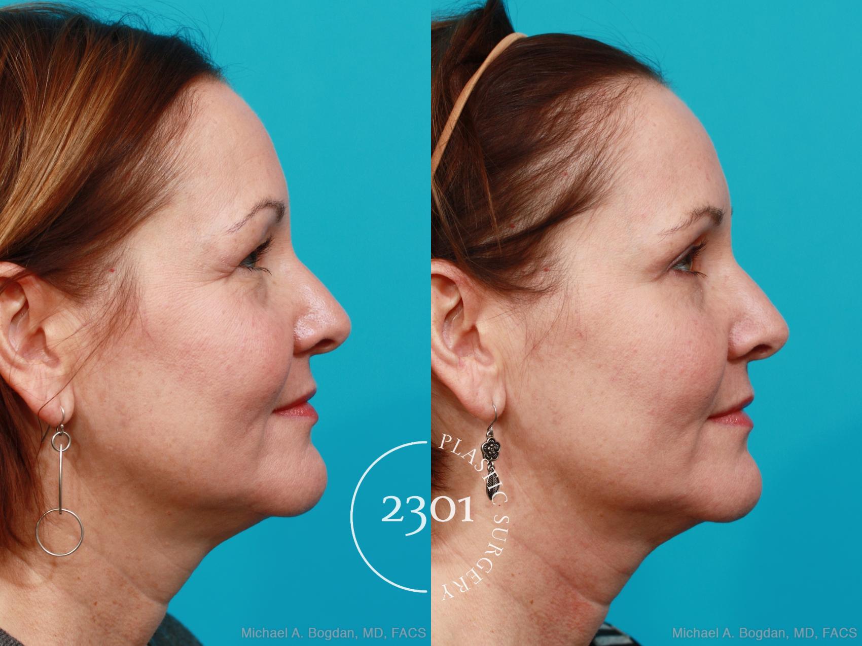 Before & After Eyelid Surgery (Upper) Case 168 View #4 View in Fort Worth, Plano, & Frisco, Texas