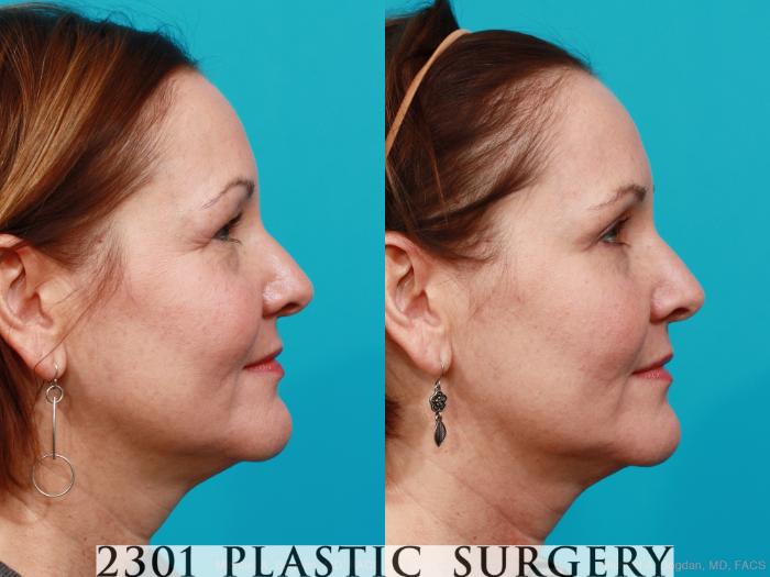 Before & After Blepharoplasty Case 168 View #4 View in Fort Worth, Plano, & Frisco, Texas