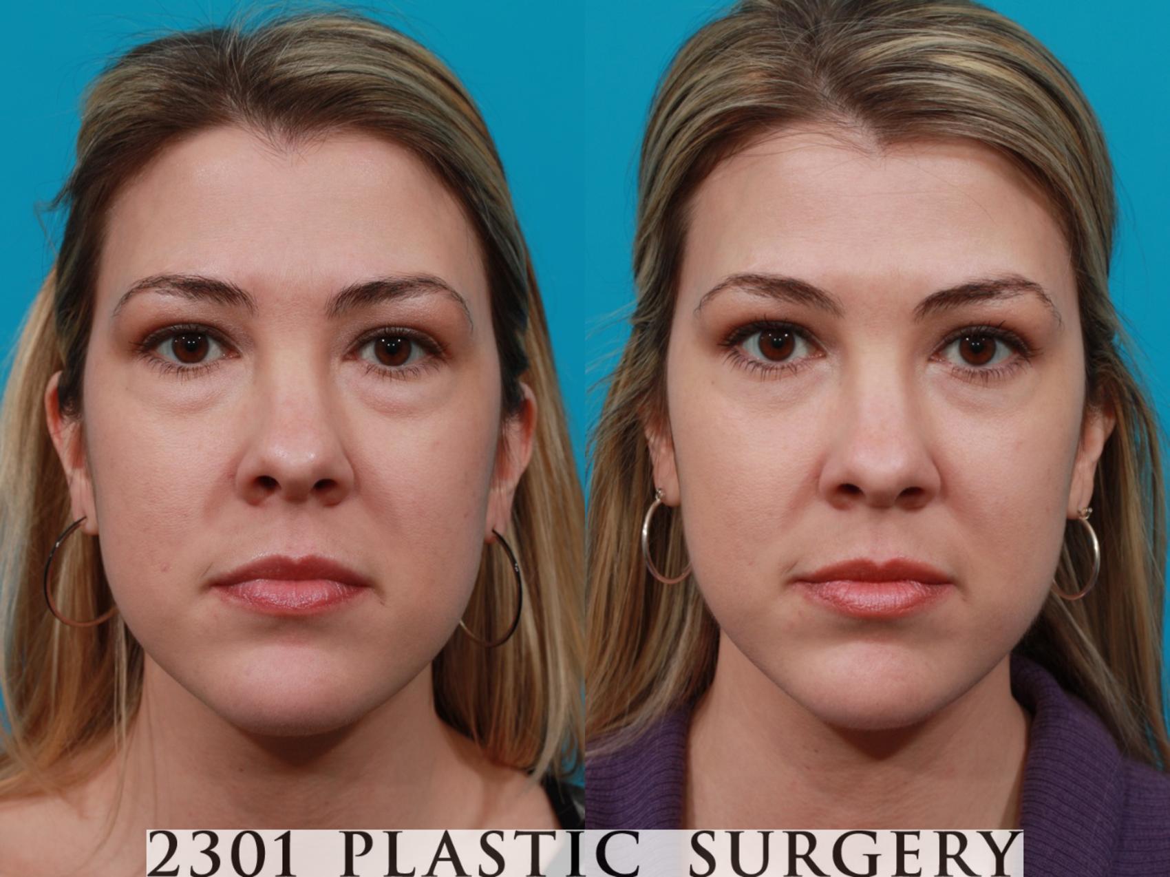 Before & After Blepharoplasty Case 192 View #1 View in Fort Worth, Plano, & Frisco, Texas