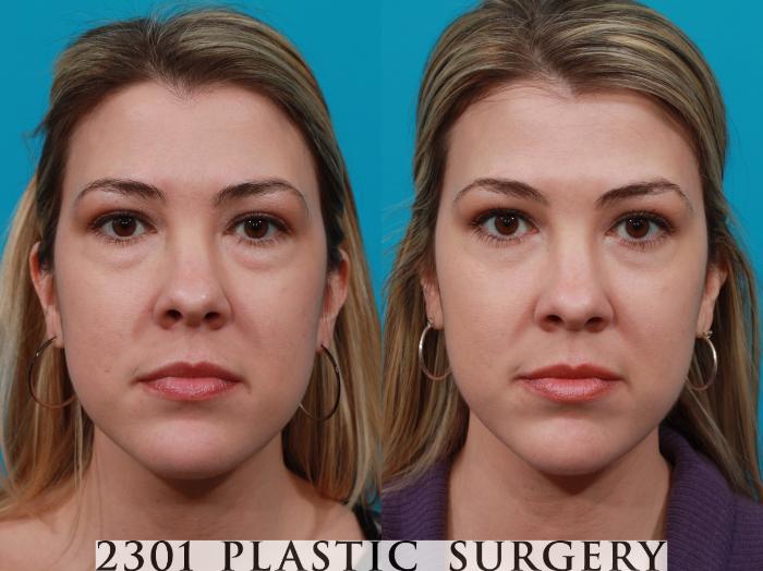 Before & After Blepharoplasty Case 192 View #1 View in Fort Worth, Plano, & Frisco, Texas