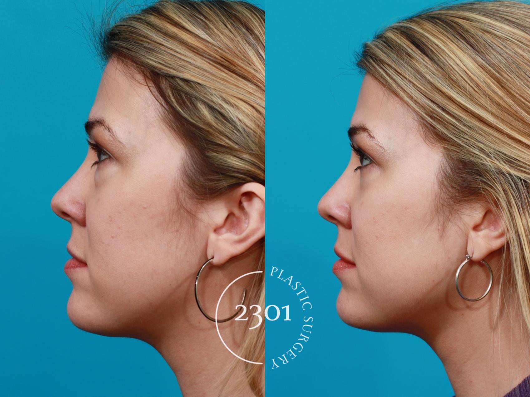 Before & After Blepharoplasty Case 192 View #2 View in Fort Worth, Plano, & Frisco, Texas