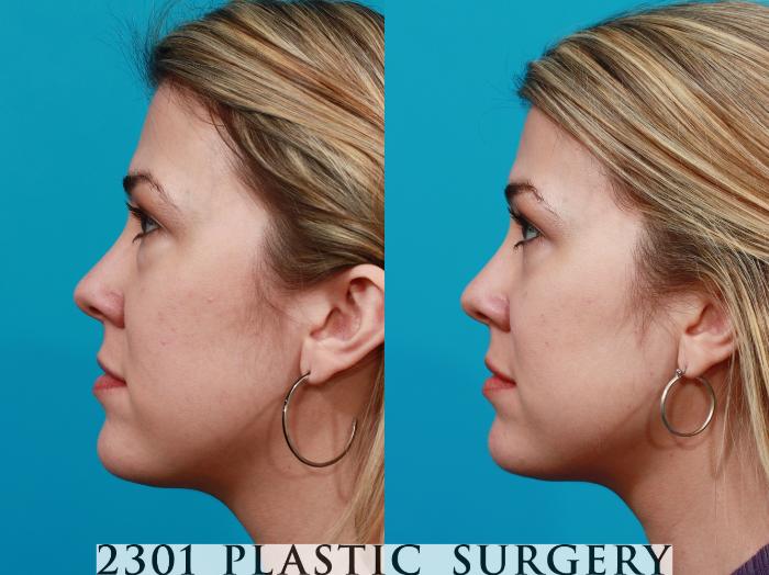 Before & After Blepharoplasty Case 192 View #2 View in Fort Worth, Plano, & Frisco, Texas
