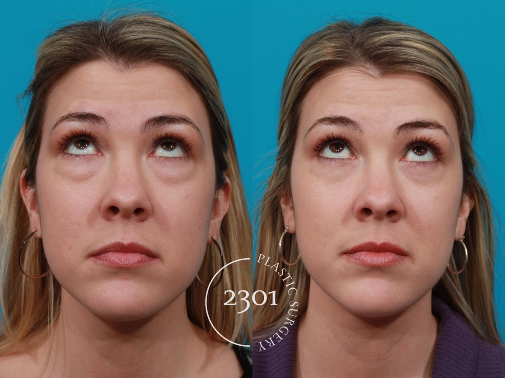 Before & After Blepharoplasty Case 192 View #3 View in Fort Worth, Plano, & Frisco, Texas