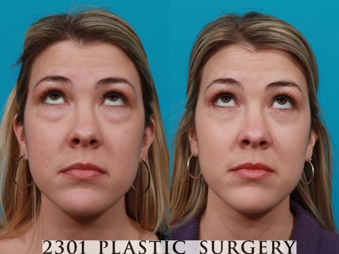 Before & After Blepharoplasty Case 192 View #3 View in Fort Worth, Plano, & Frisco, Texas