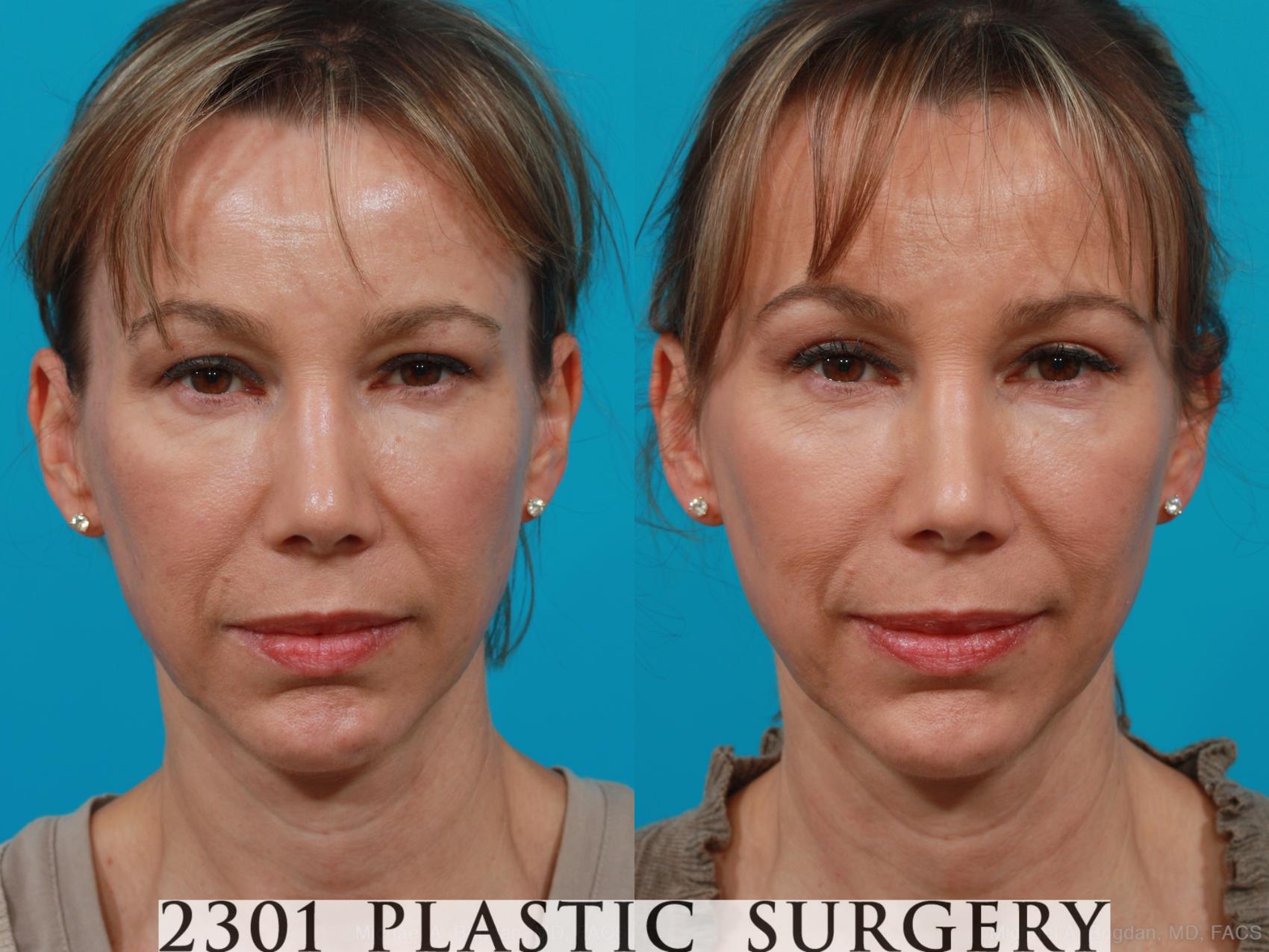 Before & After Blepharoplasty Case 209 View #1 View in Fort Worth & Frisco, Texas
