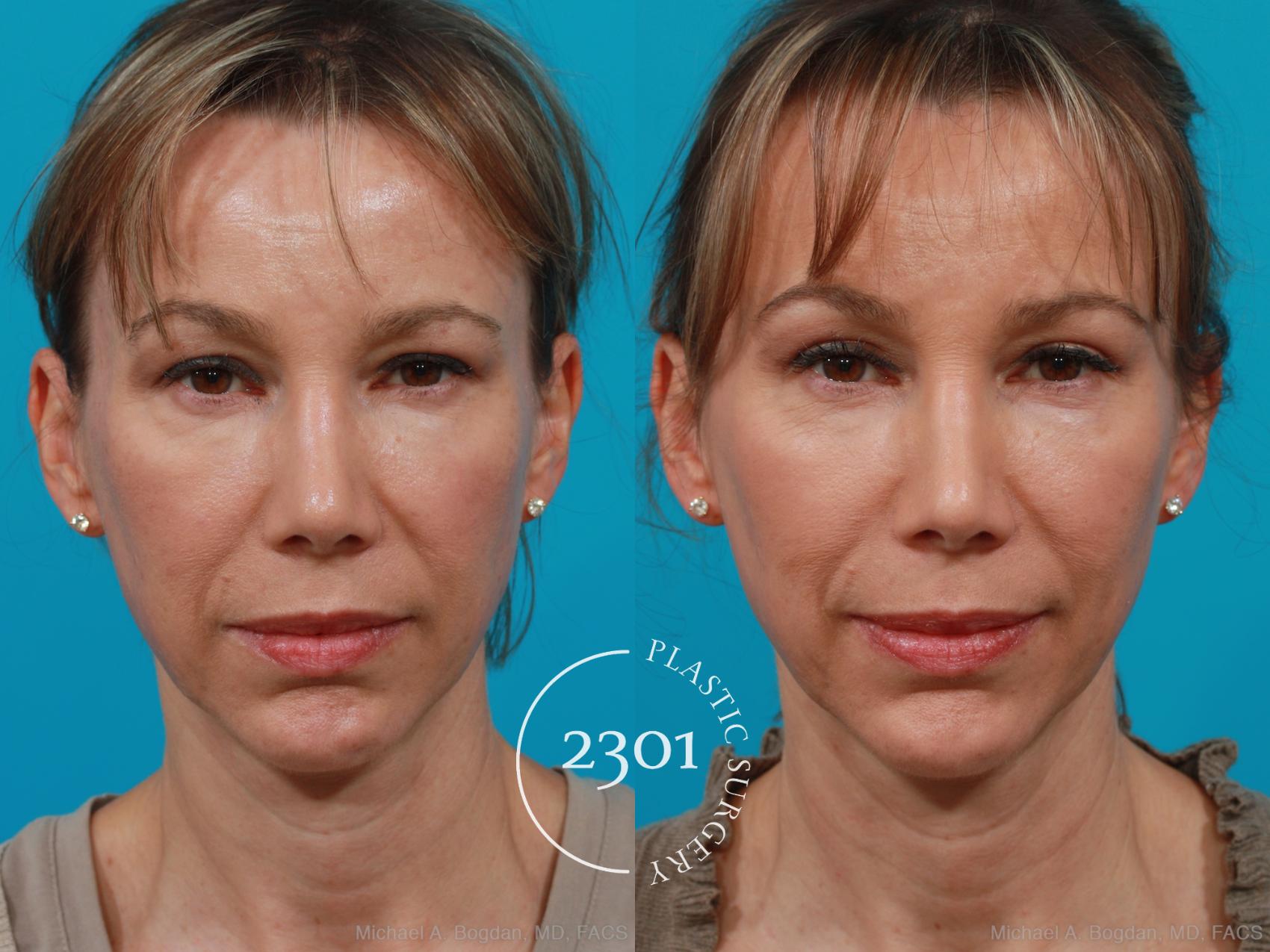 Before & After Blepharoplasty Case 209 View #1 View in Fort Worth, Plano, & Frisco, Texas