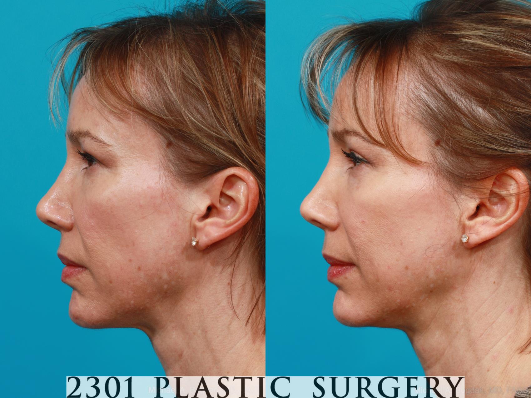 Before & After Blepharoplasty Case 209 View #2 View in Fort Worth & Frisco, Texas