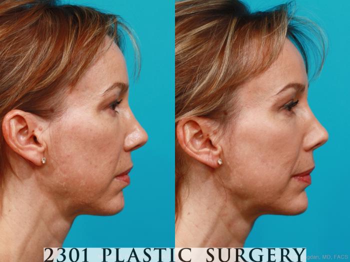 Before & After Blepharoplasty Case 209 View #3 View in Fort Worth, Plano, & Frisco, Texas