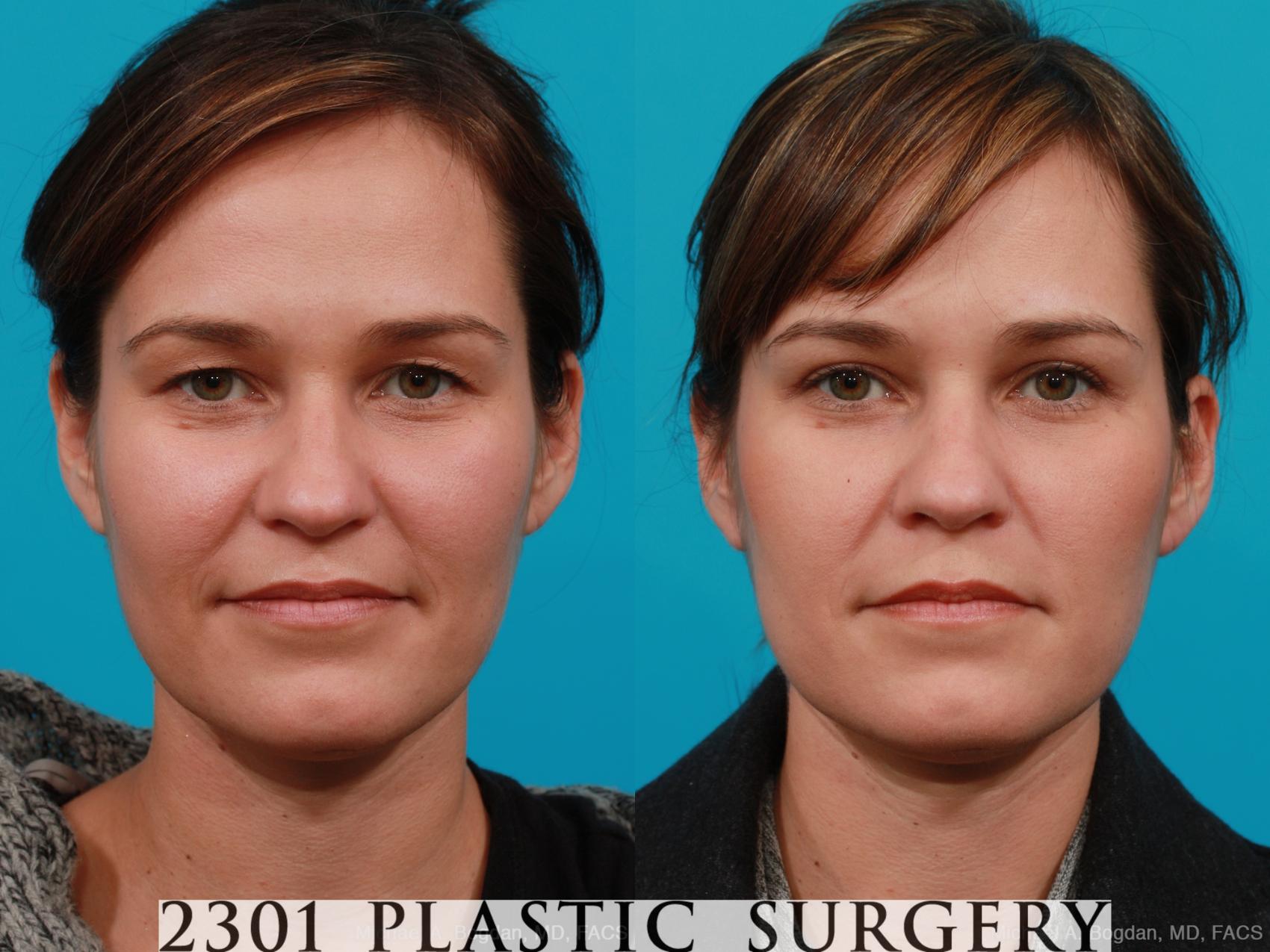 Before & After Blepharoplasty Case 215 View #1 View in Fort Worth, Plano, & Frisco, Texas