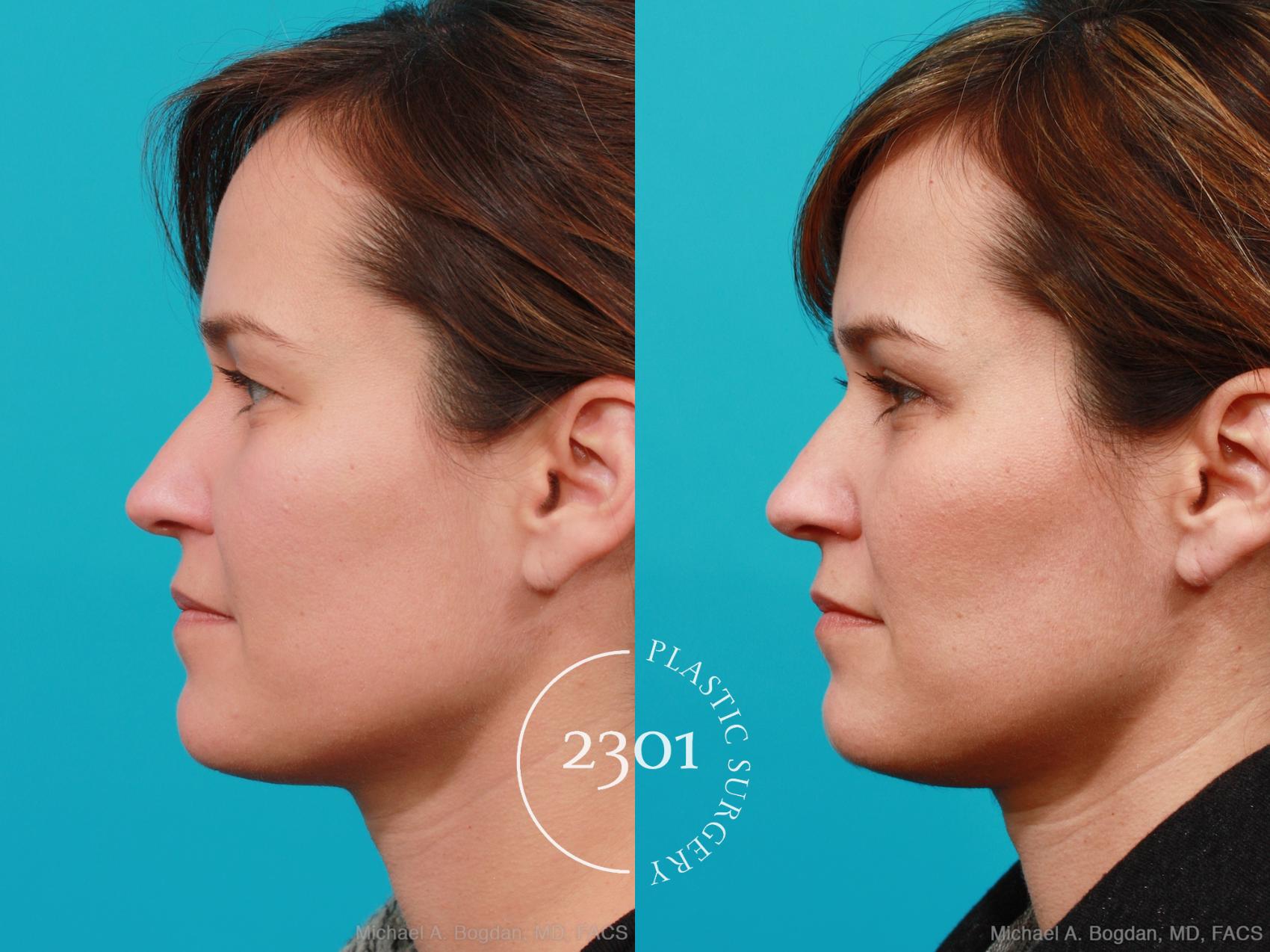Before & After Blepharoplasty Case 215 View #2 View in Fort Worth, Plano, & Frisco, Texas