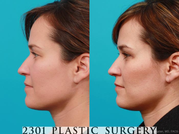 Before & After Blepharoplasty Case 215 View #2 View in Fort Worth, Plano, & Frisco, Texas
