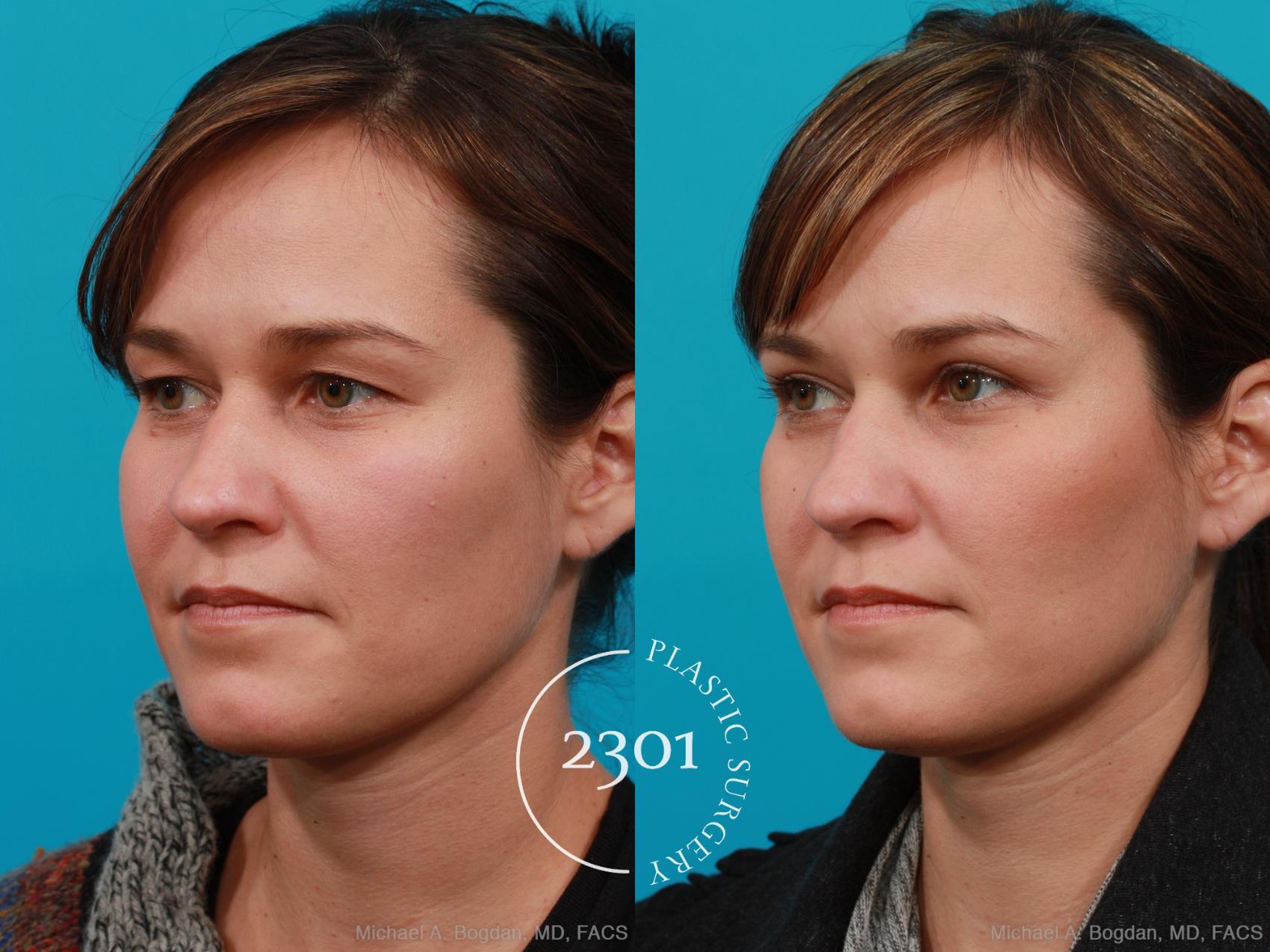Before & After Blepharoplasty Case 215 View #3 View in Fort Worth, Plano, & Frisco, Texas
