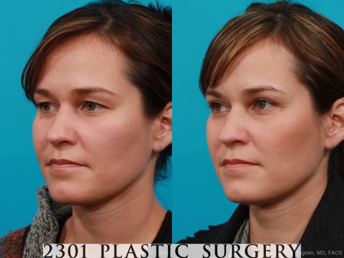 Before & After Blepharoplasty Case 215 View #3 View in Fort Worth, Plano, & Frisco, Texas