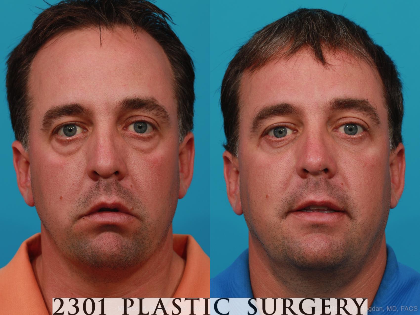 Before & After Blepharoplasty Case 229 View #1 View in Fort Worth & Frisco, Texas