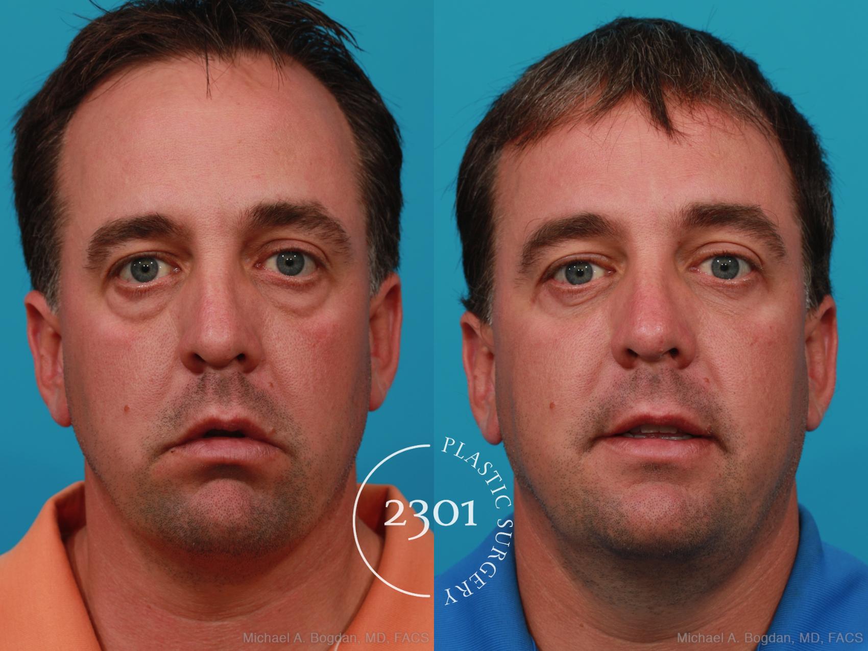 Before & After Blepharoplasty Case 229 View #1 View in Fort Worth, Plano, & Frisco, Texas