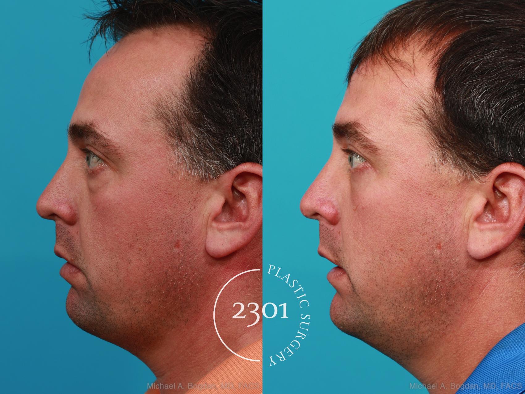 Before & After Blepharoplasty Case 229 View #3 View in Fort Worth, Plano, & Frisco, Texas