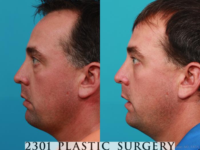 Before & After Blepharoplasty Case 229 View #3 View in Fort Worth, Plano, & Frisco, Texas
