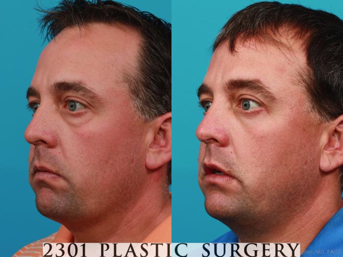 Before & After Blepharoplasty Case 229 View #4 View in Fort Worth, Plano, & Frisco, Texas
