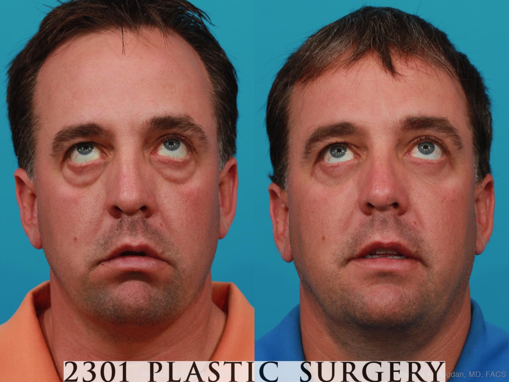 Before & After Blepharoplasty Case 229 View #5 View in Fort Worth & Frisco, Texas