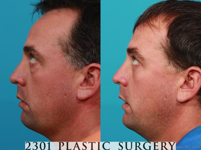 Before & After Blepharoplasty Case 229 View #6 View in Fort Worth, Plano, & Frisco, Texas